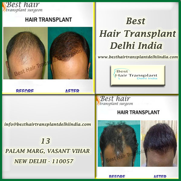 FUT hair transplant Delhi, FUE hair transplant in Delhi, scalp reduction surgery cost in India, hair transplant surgery India It goes without saying that losing hair is an extremely traumatic experience for all and sundry. However, the moment you get to know that there is a ray of hope for you to get your hair back; it appears nothing short of a miracle. Over the last few years, there have emerged several methods of restoring hair. There are different types of hair transplant procedures which can be your key to regain hair. If you are considering hair transplant surgery India then FUT, FUE and scalp reduction make for the most popular methods.  FUE  Also known as Follicular Unit Extraction, it is counted among the most advanced and modern techniques hair transplantation. It assured complete natural look. It is far more sophisticated technique of treating hair loss. It is one of the main reasons you should choose surgeon with great care for FUE hair transplant in Delhi. In this procedure, no incisions are made which means no scars and sutures.  FUT  Follicular Unit Transplant, also known as strip surgery, is one of the most commonly performed procedures for treating hair loss and is considered as an ideal choice for those who have large areas of baldness. In this method, skin parts having hair is removed making use of scalpel from the back of the head and then hair is transplanted at the bald area. FUT hair transplant Delhi can help you regain hair growth in the most effective way possible.  Scalp reduction surgery  It is a surgical treatment for removing parts of the scalp which get affected by alopecia. The main purpose is to reduce the overall area of the bald skin.Then the healthier parts of the scalp are stretched and re-positioned which makes the bald area manageable and smaller. You can find out about the scalp reduction surgery cost in India by consulting a hair transplant surgeon and make the right decision.  Please call our patient co-ordinator or fill the online appointment form, to get an exact cost of your hair transplant surgery. For further details and expert advice call us on 9958221983 or visit our clinic at www.besthairtransplantdelhiindia.com  13A, Palam Marg, Vasant Vihar, NEW DELHI-110057 (INDIA) Mobile: +91-9958221983 Mail: info@besthairtransplantsurgeon.com Tag: FUT hair transplant Delhi, FUE hair transplant in Delhi, scalp reduction surgery cost in India, hair transplant surgery India