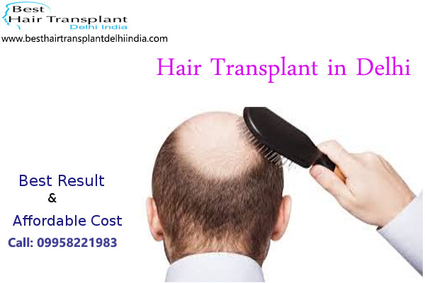 #scalpreduction, #prptreatment, #besthairtransplant, #hairsurgeon, #FUE, #FUT, #moustaches, #mesotherapy, #hairreplacmentcost, #eyelasheshairtransplant, #eyebrowhairtransplant, #beardtransplant, #hairsurgerycost, #besthairtransplantdelhiindia, #hairreplacementsurgery, #hairimplantsurgery, #hairfalltreatment